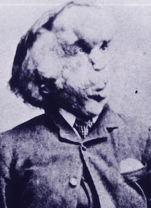 Joseph Merrick